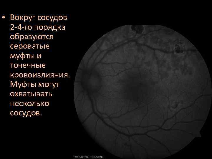  • Вокруг сосудов 2 -4 -го порядка образуются сероватые муфты и точечные кровоизлияния.