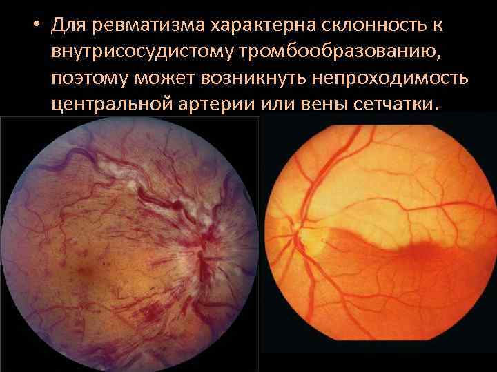  • Для ревматизма характерна склонность к внутрисосудистому тромбообразованию, поэтому может возникнуть непроходимость центральной