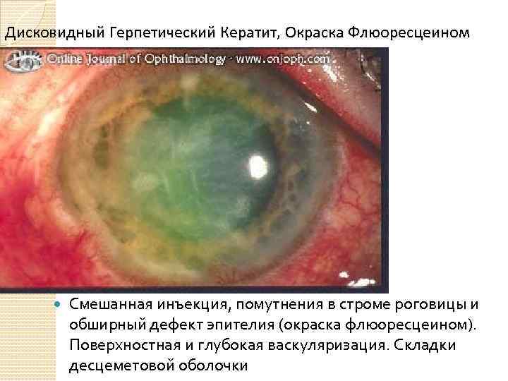 Дисковидный Герпетический Кератит, Окраска Флюоресцеином Смешанная инъекция, помутнения в строме роговицы и обширный дефект