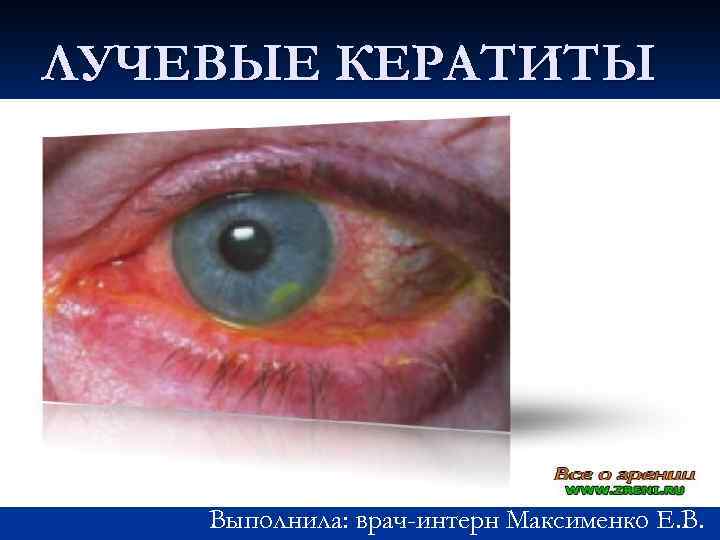 ЛУЧЕВЫЕ КЕРАТИТЫ Выполнила: врач-интерн Максименко Е. В. 