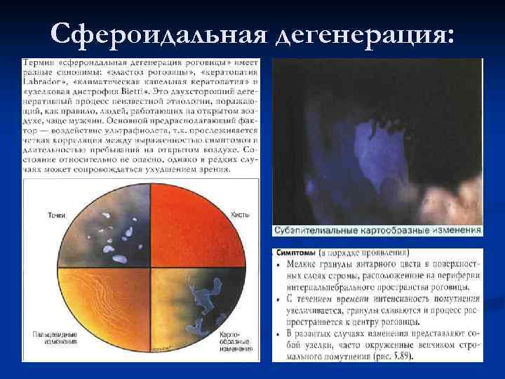 Сфероидальная дегенерация: 