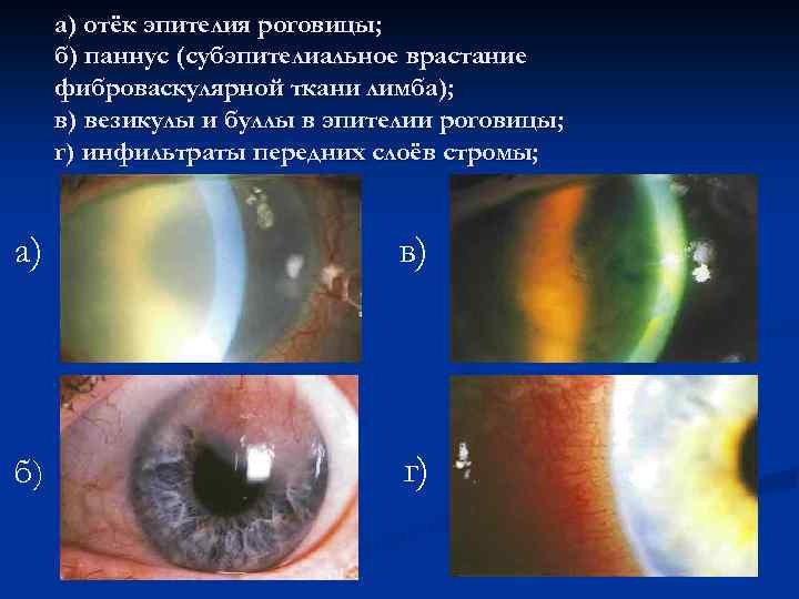 а) отёк эпителия роговицы; б) паннус (субэпителиальное врастание фиброваскулярной ткани лимба); в) везикулы и