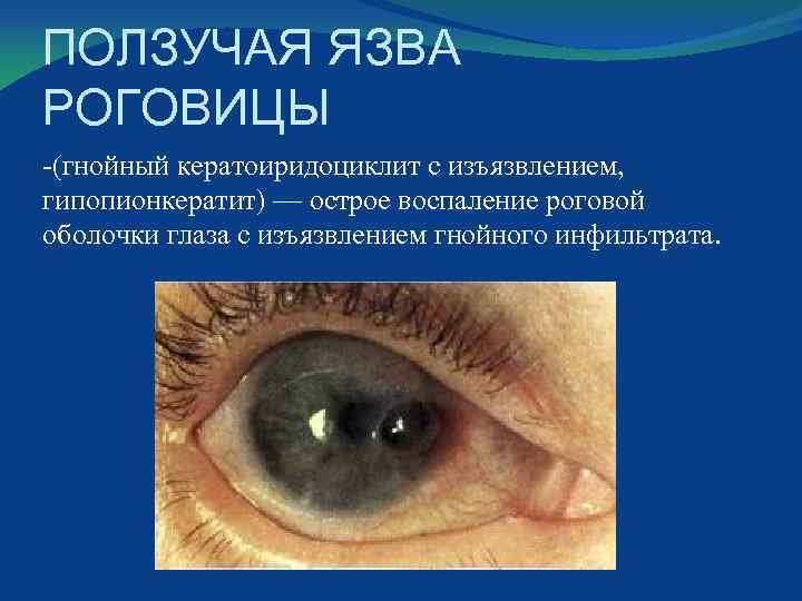 ПОЛЗУЧАЯ ЯЗВА РОГОВИЦЫ -(гнойный кератоиридоциклит с изъязвлением, гипопионкератит) — острое воспаление роговой оболочки глаза