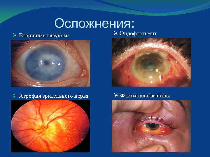 Осложнения: Ø Вторичная глаукома Ø Эндофтальмит Ø Атрофия зрительного нерва Ø Флегмона глазницы 