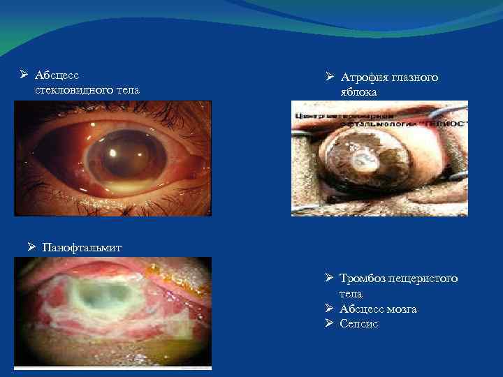 Ø Абсцесс стекловидного тела Ø Атрофия глазного яблока Ø Панофтальмит Ø Тромбоз пещеристого тела