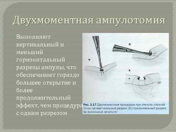 Двухмоментная ампулотомия Выполняют вертикальный и меньший горизонтальный разрезы ампулы, что обеспечивает гораздо большее открытие