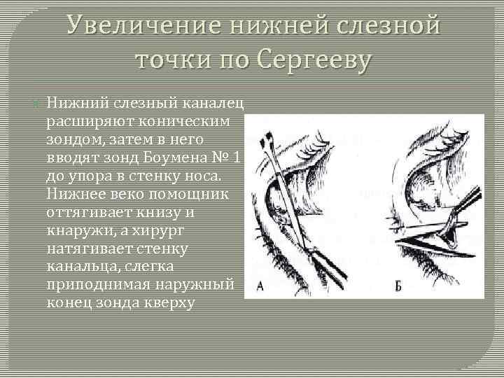 Увеличение нижней слезной точки по Сергееву Нижний слезный каналец расширяют коническим зондом, затем в