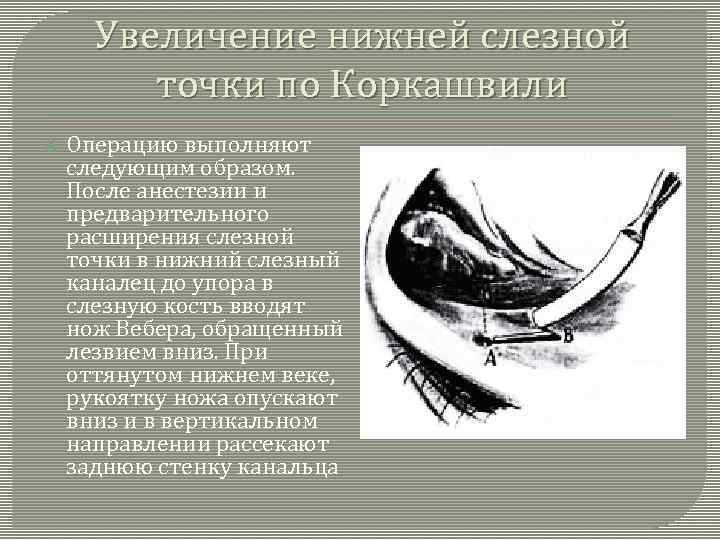 Увеличение нижней слезной точки по Коркашвили Операцию выполняют следующим образом. После анестезии и предварительного