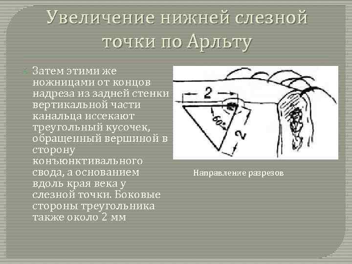 Увеличение нижней слезной точки по Арльту Затем этими же ножницами от концов надреза из