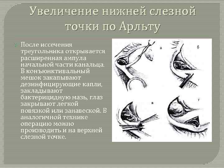 Увеличение нижней слезной точки по Арльту После иссечения треугольника открывается расширенная ампула начальной части