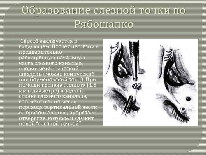 Образование слезной точки по Рябошапко Способ заключается в следующем. После анестезии в предварительно расширенную