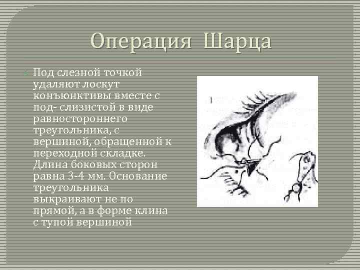 Операция Шарца Под слезной точкой удаляют лоскут конъюнктивы вместе с под- слизистой в виде