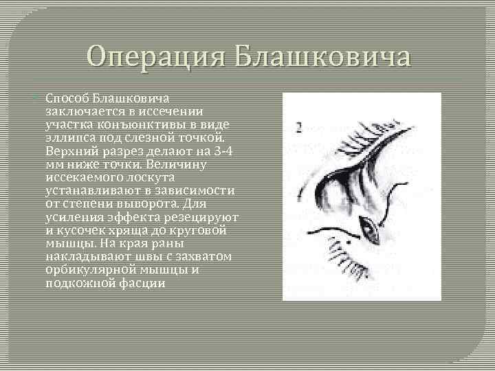 Операция Блашковича Способ Блашковича заключается в иссечении участка конъюнктивы в виде эллипса под слезной