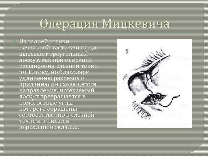 Операция Мицкевича Из задней стенки начальной части канальца вырезают треугольный лоскут, как при операции