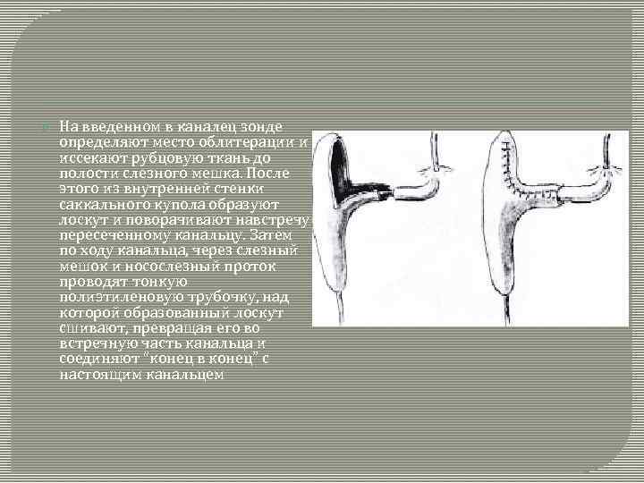 На введенном в каналец зонде определяют место облитерации и иссекают рубцовую ткань до