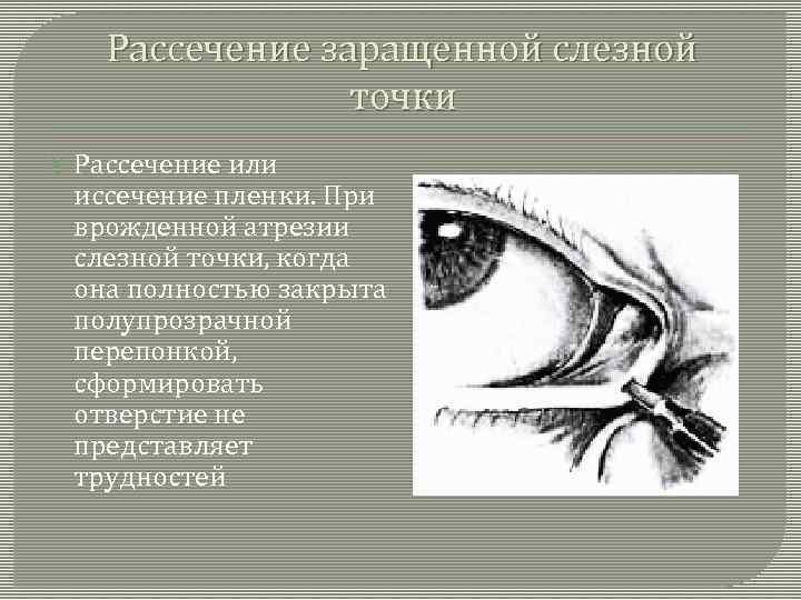 Рассечение заращенной слезной точки Рассечение или иссечение пленки. При врожденной атрезии слезной точки, когда