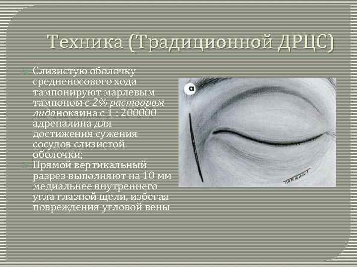 Техника (Традиционной ДРЦС) Слизистую оболочку средненосового хода тампонируют марлевым тампоном с 2% раствором лидонокаина