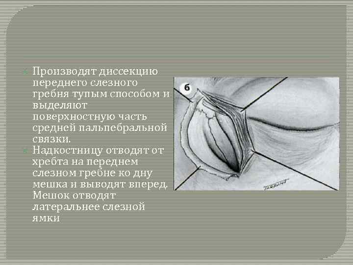  Производят диссекцию переднего слезного гребня тупым способом и выделяют поверхностную часть средней пальпебральной