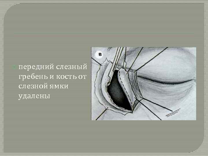  передний слезный гребень и кость от слезной ямки удалены 