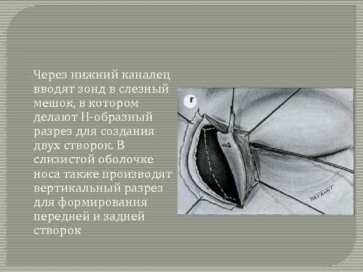  Через нижний каналец вводят зонд в слезный мешок, в котором делают Н-образный разрез