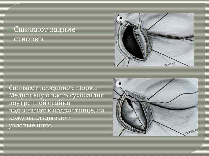  Сшивают задние створки Сшивают передние створки. Медиальную часть сухожилия внутренней спайки подшивают к