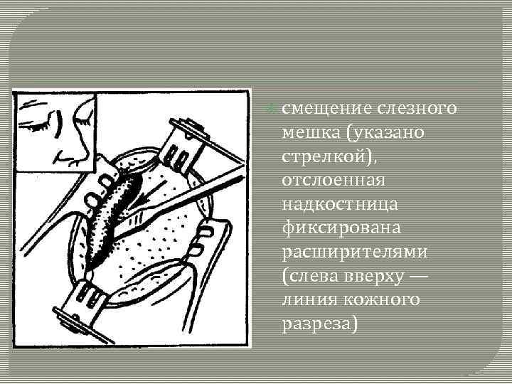  смещение слезного мешка (указано стрелкой), отслоенная надкостница фиксирована расширителями (слева вверху — линия