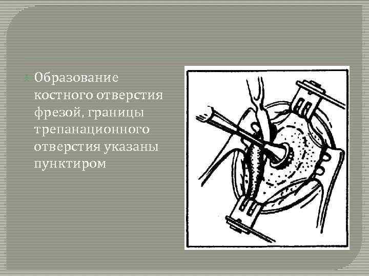  Образование костного отверстия фрезой, границы трепанационного отверстия указаны пунктиром 