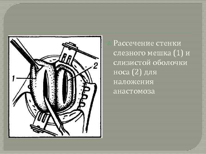  Рассечение стенки слезного мешка (1) и слизистой оболочки носа (2) для наложения анастомоза