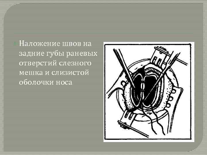  Наложение швов на задние губы раневых отверстий слезного мешка и слизистой оболочки носа
