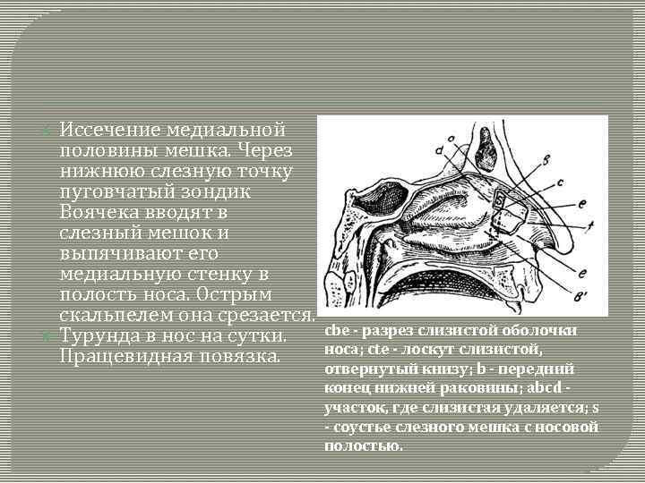  Иссечение медиальной половины мешка. Через нижнюю слезную точку пуговчатый зондик Воячека вводят в