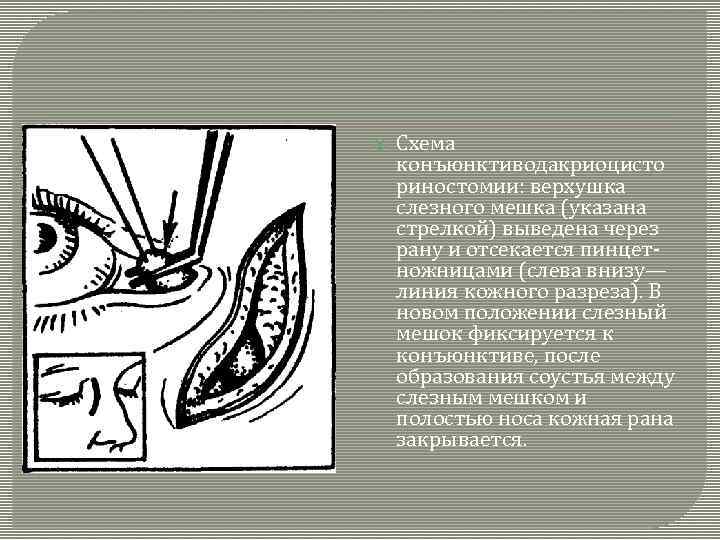  Схема конъюнктиводакриоцисто риностомии: верхушка слезного мешка (указана стрелкой) выведена через рану и отсекается