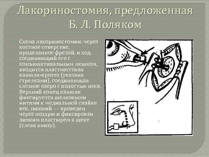 Лакориностомия, предложенная Б. Л. Поляком Схема лакориностомии: через костное отверстие, проделанное фрезой, и ход,