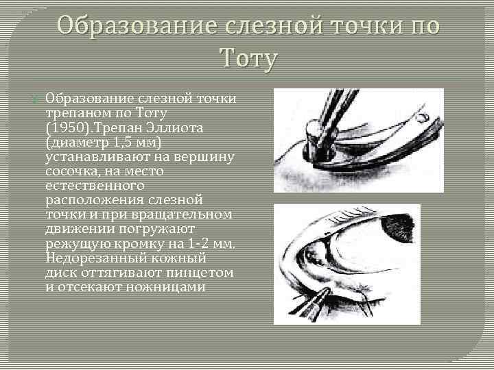 Образование слезной точки по Тоту Образование слезной точки трепаном по Тоту (1950). Трепан Эллиота