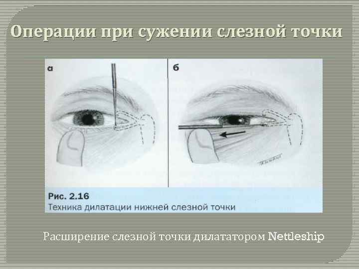Операции при сужении слезной точки Расширение слезной точки дилататором Nettleship 
