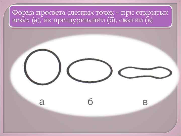 Форма просвета слезных точек – при открытых веках (а), их прищуривании (б), сжатии (в)