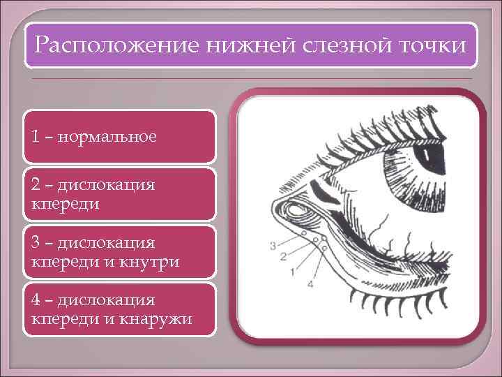 Расположение нижней слезной точки 1 – нормальное 2 – дислокация кпереди 3 – дислокация