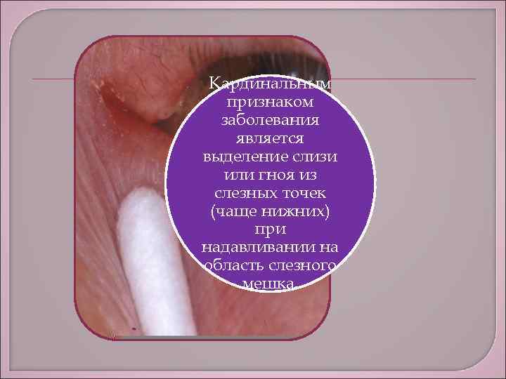 Кардинальным признаком заболевания является выделение слизи или гноя из слезных точек (чаще нижних) при