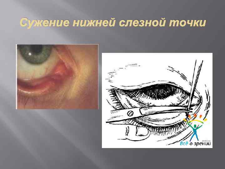 Сужение нижней слезной точки 