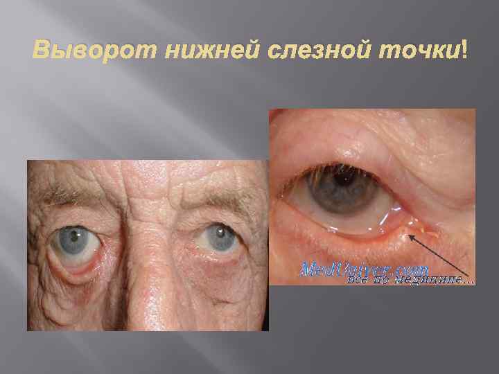 Выворот нижней слезной точки 