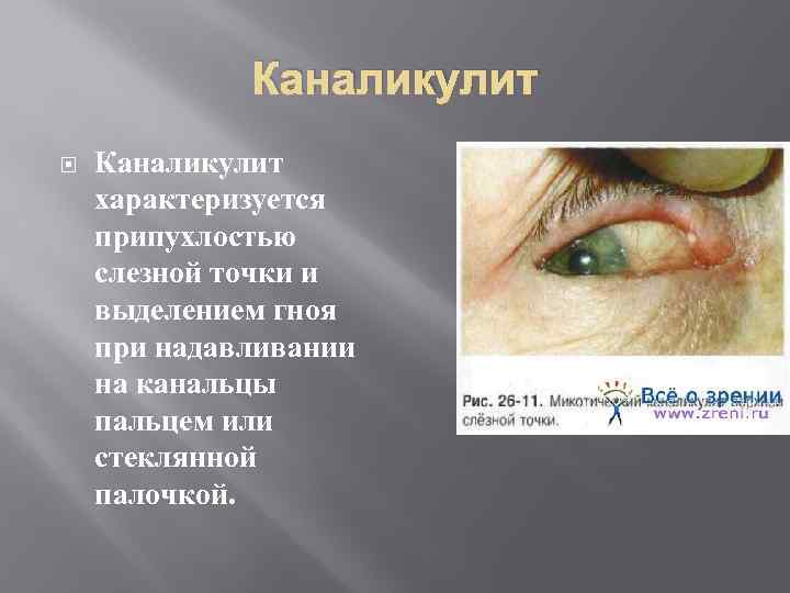 Каналикулит характеризуется припухлостью слезной точки и выделением гноя при надавливании на канальцы пальцем или