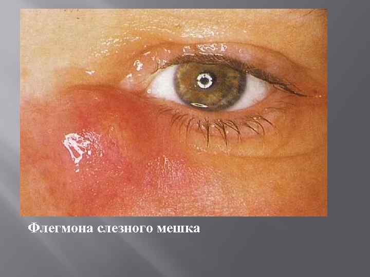 Флегмона слезного мешка 