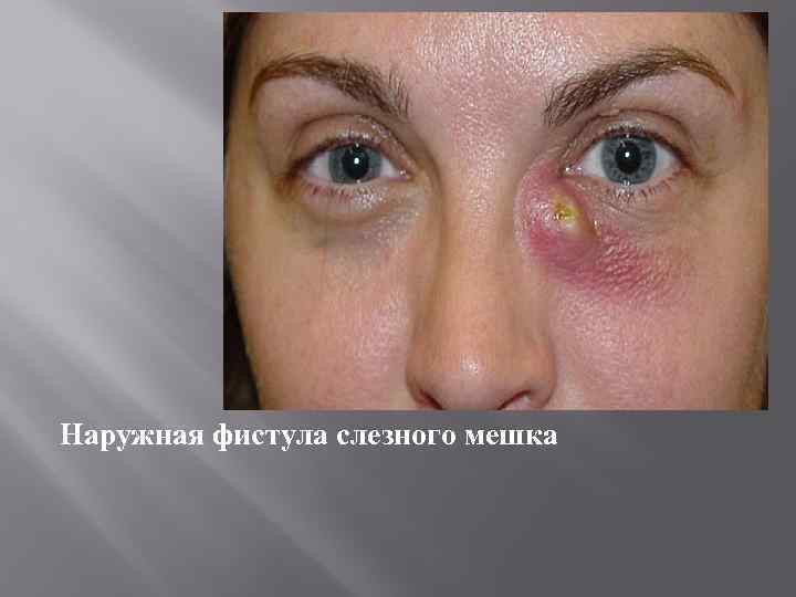 Наружная фистула слезного мешка 