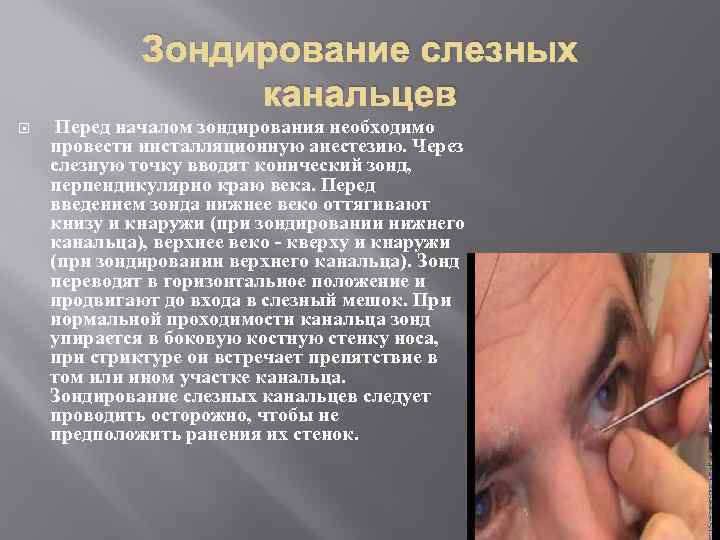 Зондирование слезных канальцев Перед началом зондирования необходимо провести инсталляционную анестезию. Через слезную точку вводят