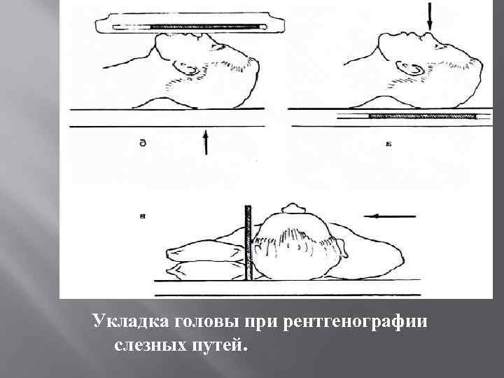Укладка головы при рентгенографии слезных путей. 