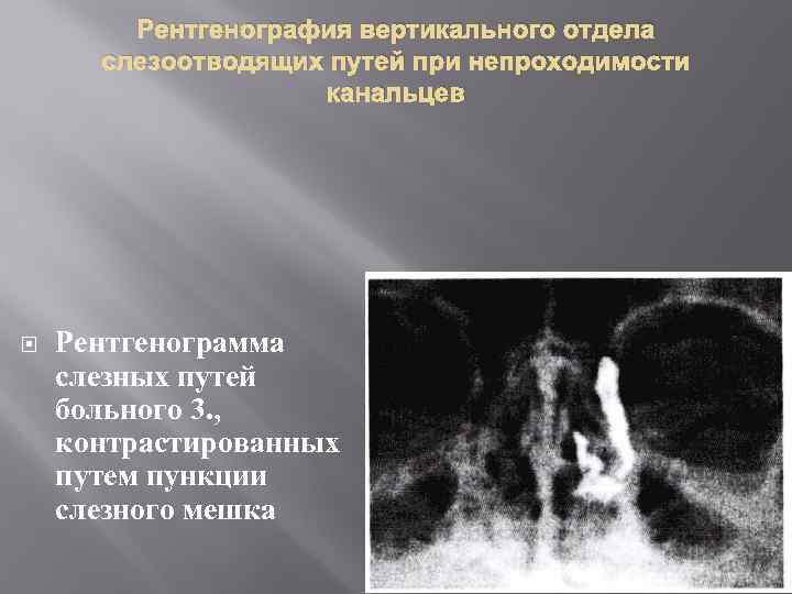 Рентгенография вертикального отдела слезоотводящих путей при непроходимости канальцев Рентгенограмма слезных путей больного 3. ,