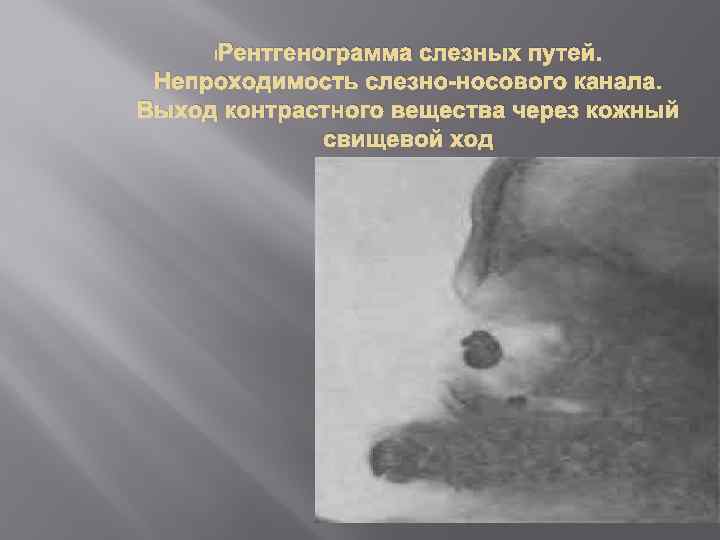 Рентгенограмма слезных путей. Непроходимость слезно-носового канала. Выход контрастного вещества через кожный свищевой ход 