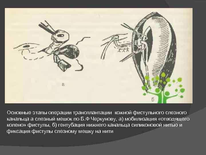 Основные этапы операции трансплантации кожной фистульного слезного канальца а слезный мешок по Б. Ф