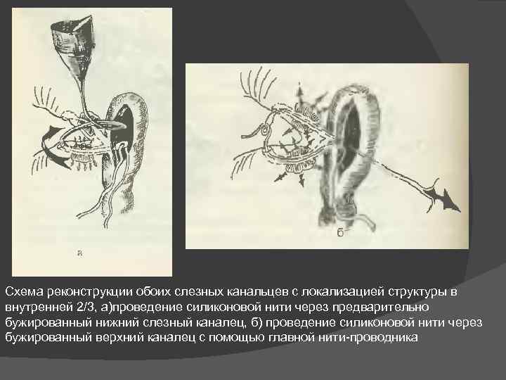 Схема реконструкции обоих слезных канальцев с локализацией структуры в внутренней 2/3, а)проведение силиконовой нити