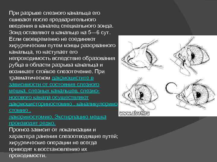 При разрыве слезного канальца его сшивают после предварительного введения в каналец специального зонда. Зонд