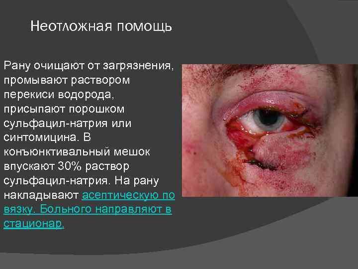 Неотложная помощь Рану очищают от загрязнения, промывают раствором перекиси водорода, присыпают порошком сульфацил-натрия или